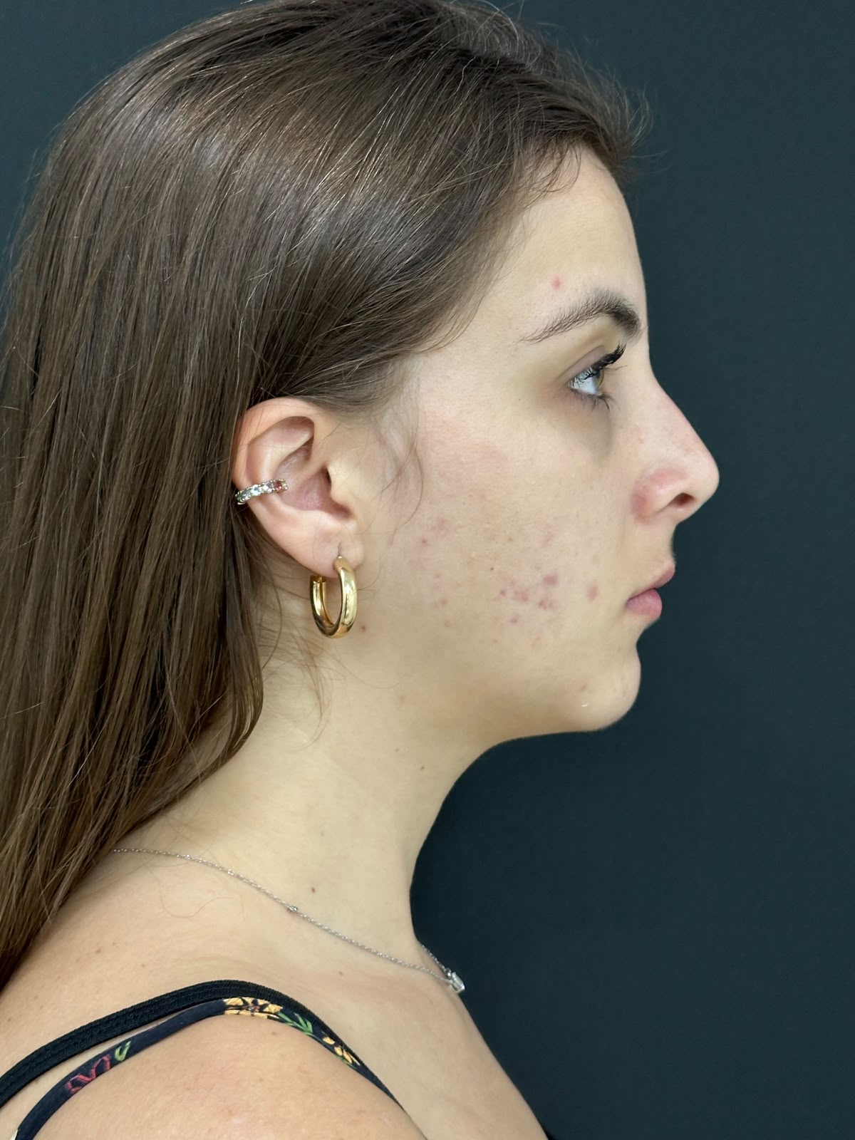 Perfil nasal antes da rinoplastia — caso 1