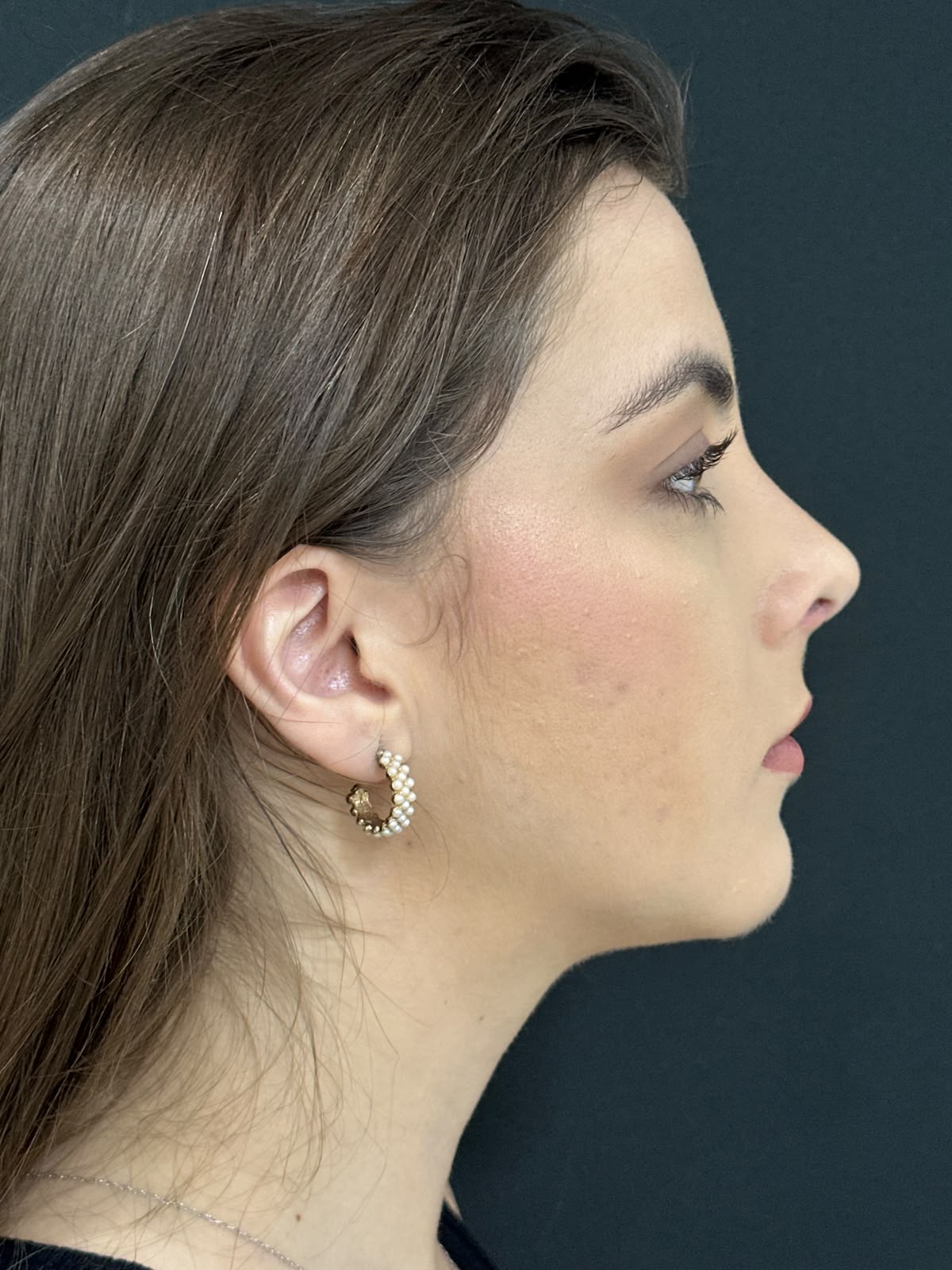 Perfil nasal depois da rinoplastia — caso 1