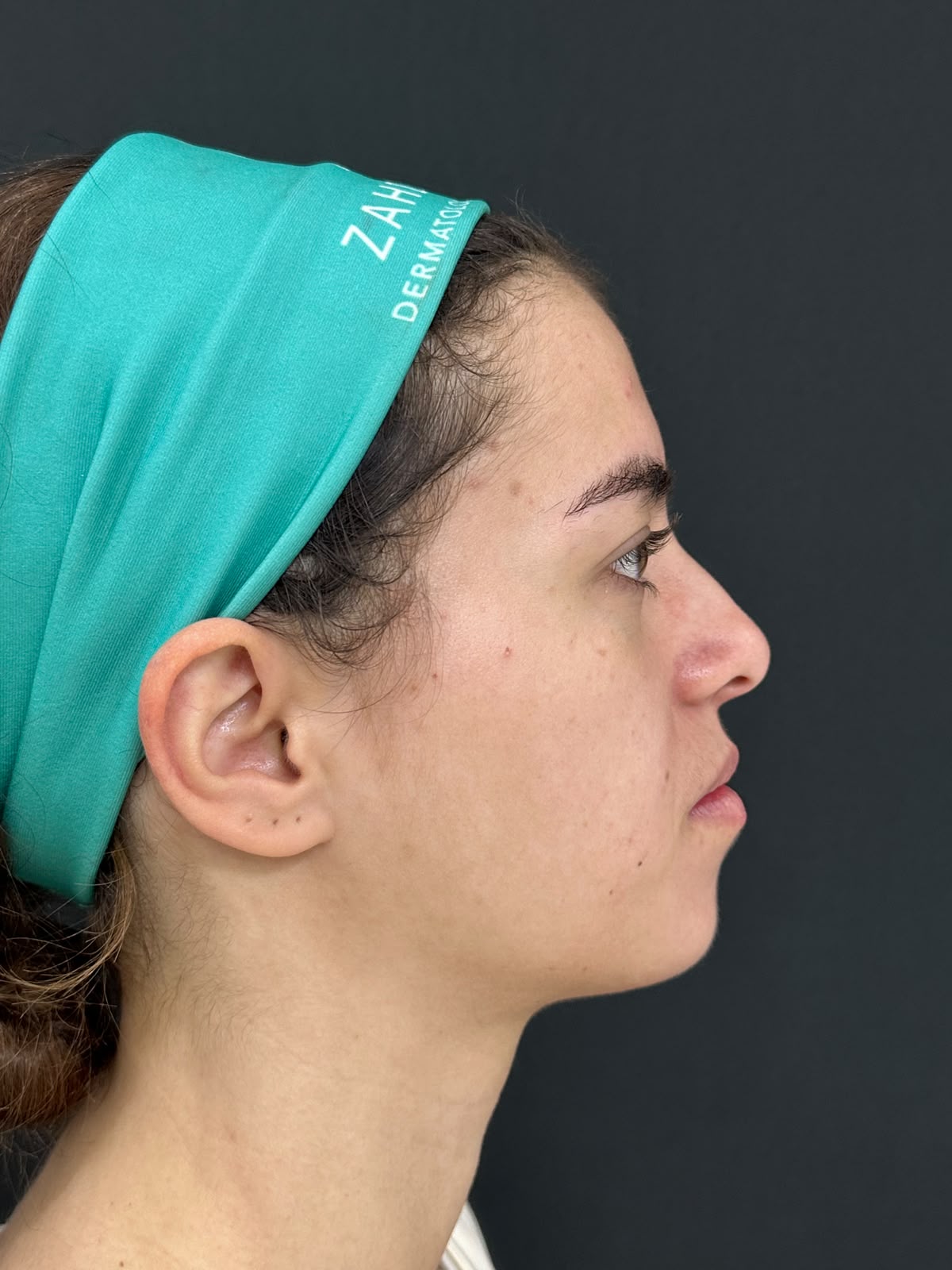 Perfil nasal antes da rinoplastia — caso 2