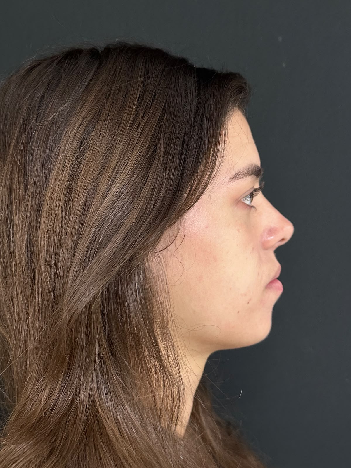 Perfil nasal depois da rinoplastia — caso 2