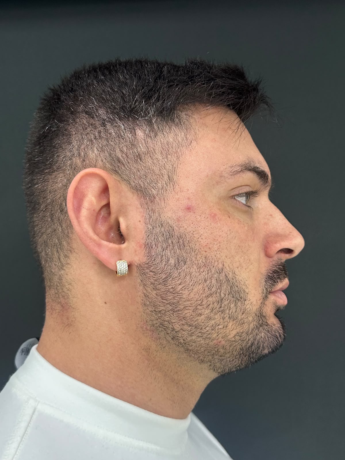 Perfil nasal antes da rinoplastia — caso 3