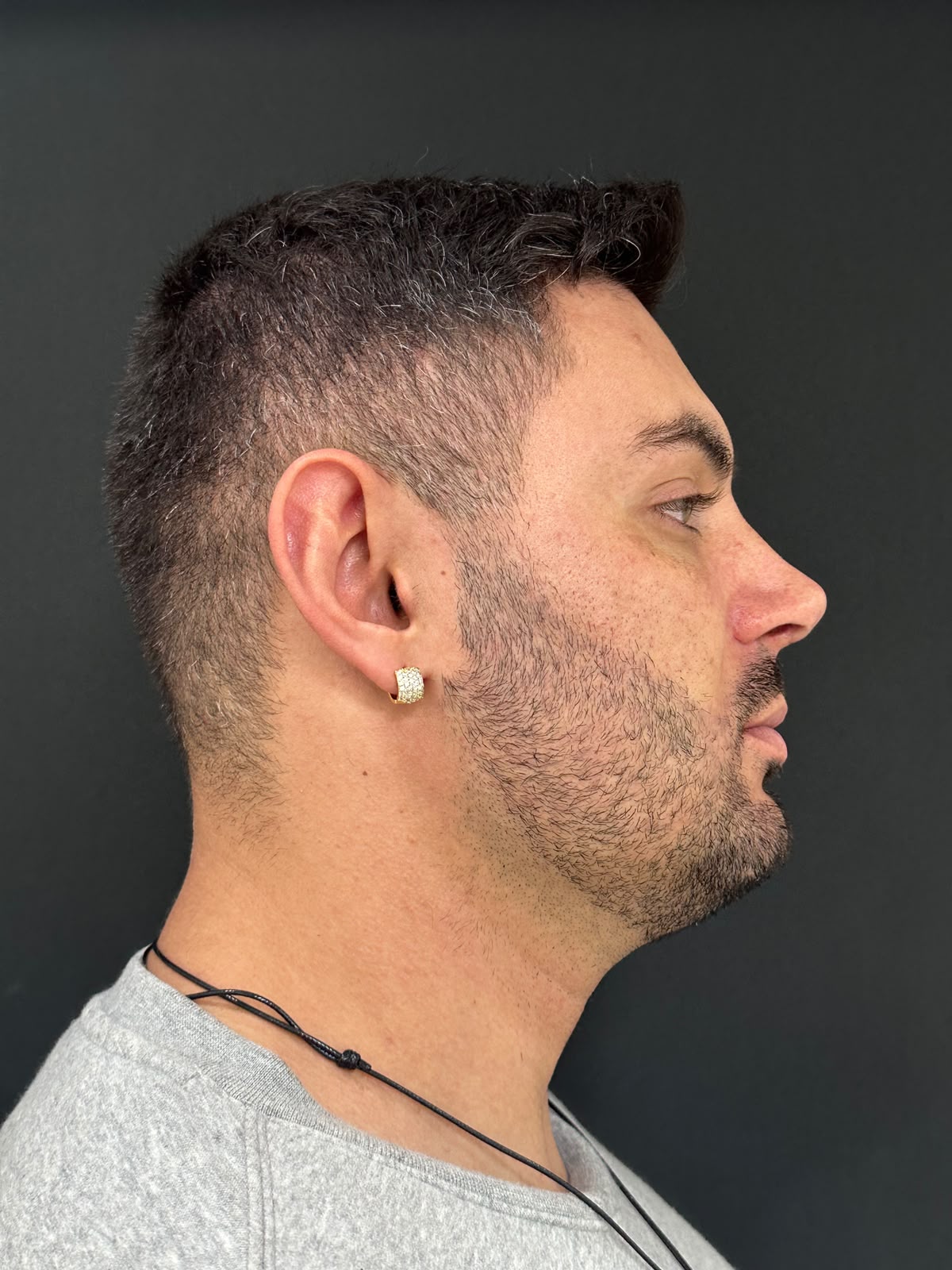 Perfil nasal depois da rinoplastia — caso 3