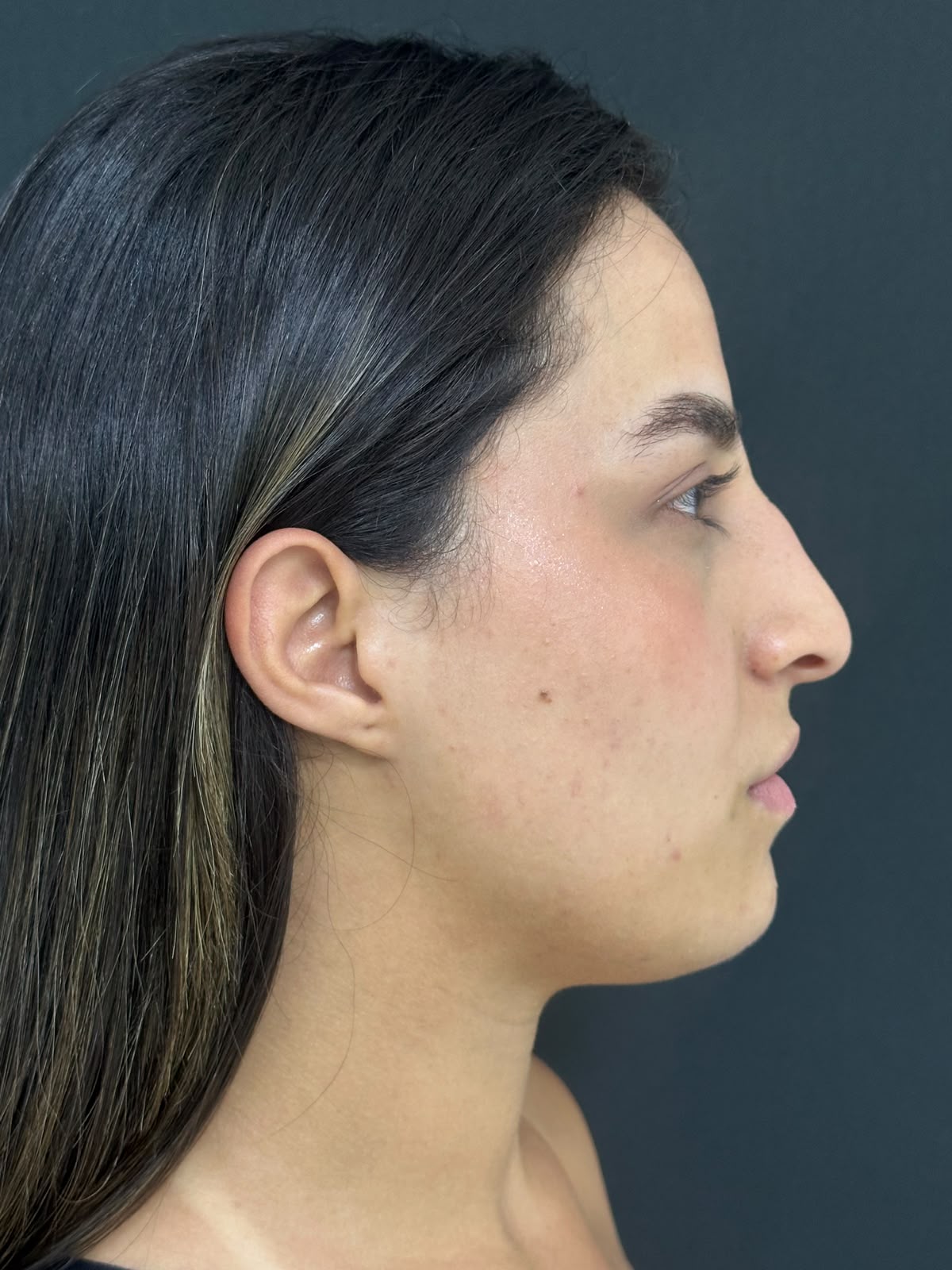 Perfil nasal antes da rinoplastia — caso 4