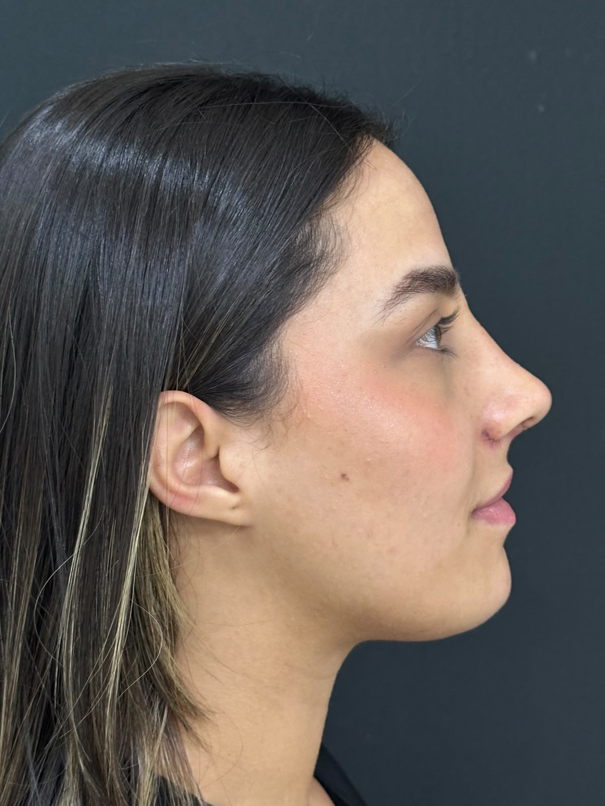Perfil nasal depois da rinoplastia — caso 4