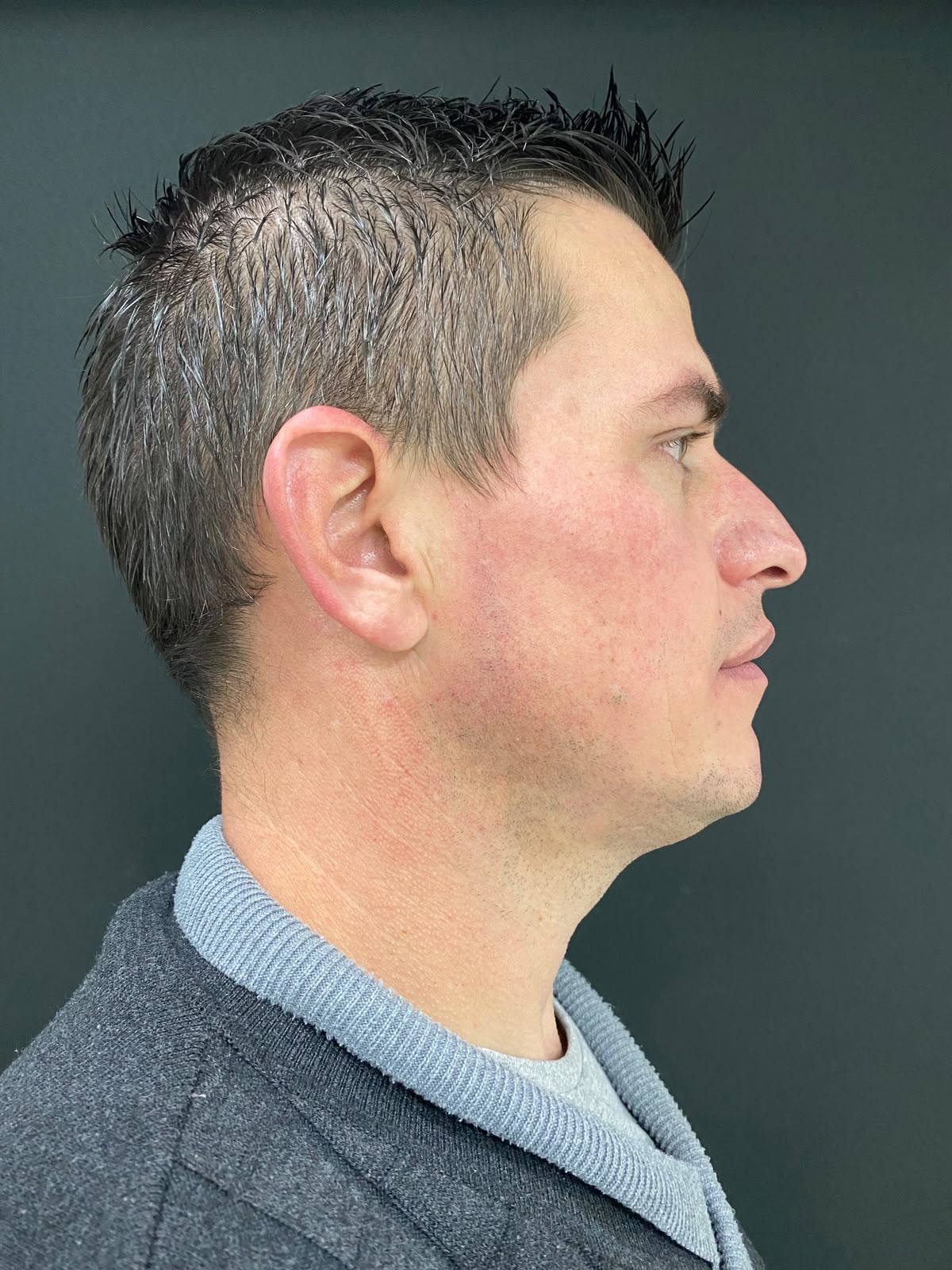 Perfil nasal antes da rinoplastia — caso 5