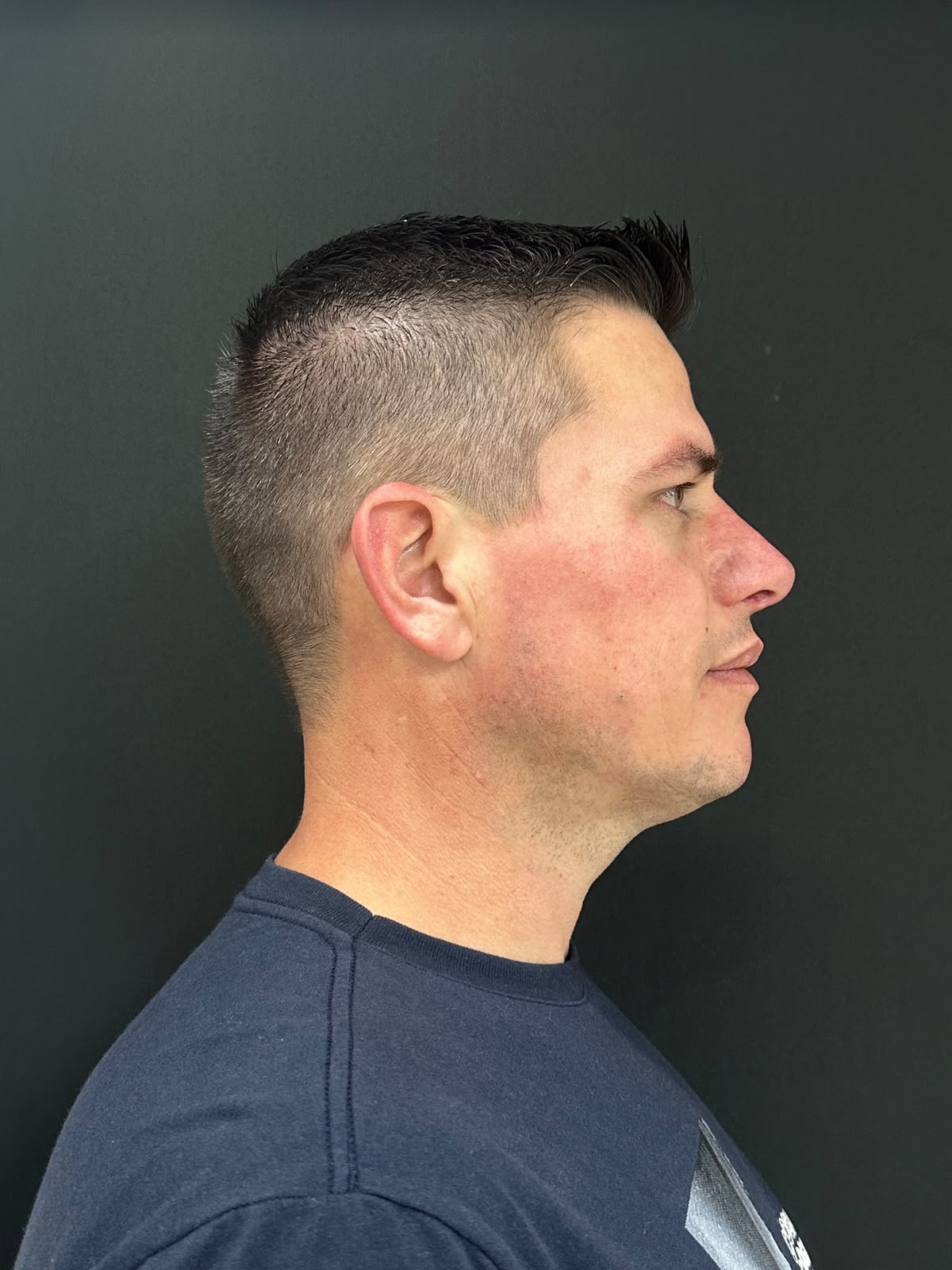 Perfil nasal depois da rinoplastia — caso 5