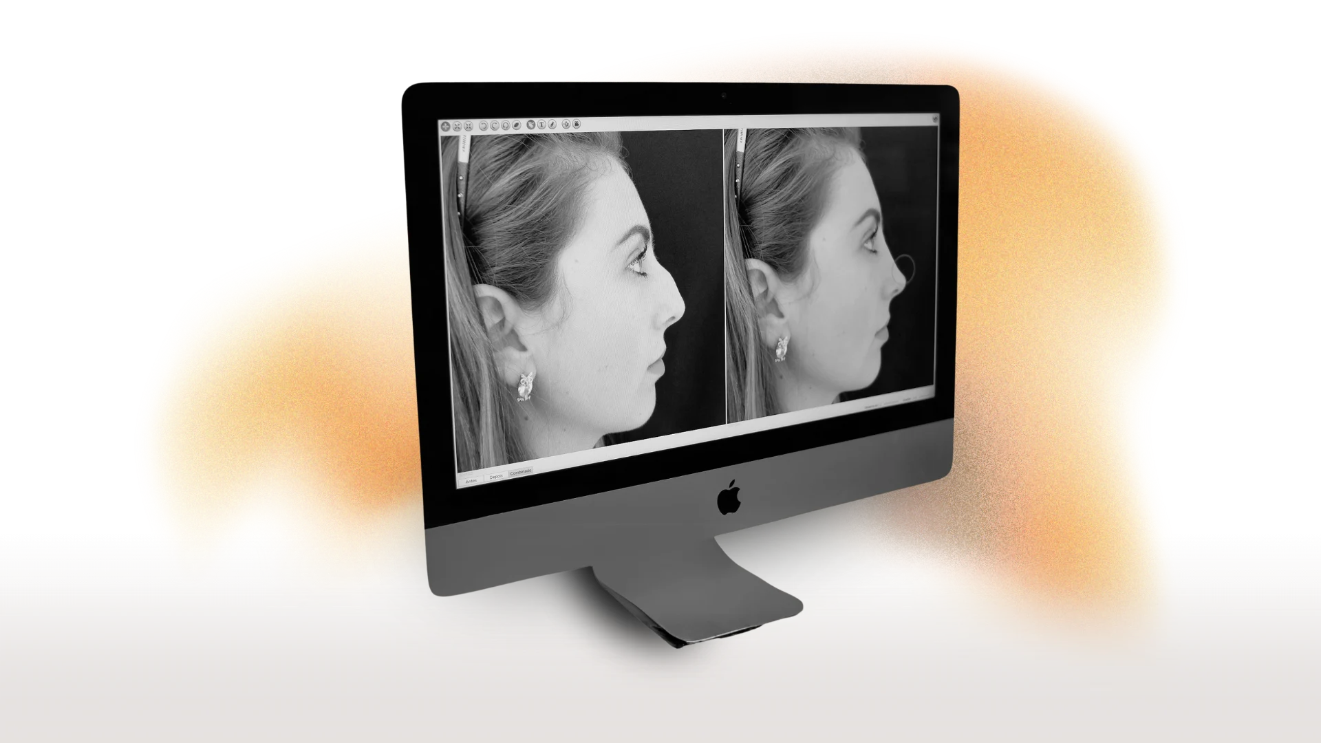Software de simulação 3D mostrando comparativo de perfil antes e depois de rinoplastia